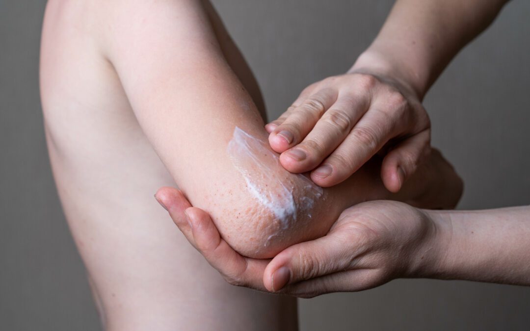 Eczema Treatments: From Topicals to Therapies—What Works?