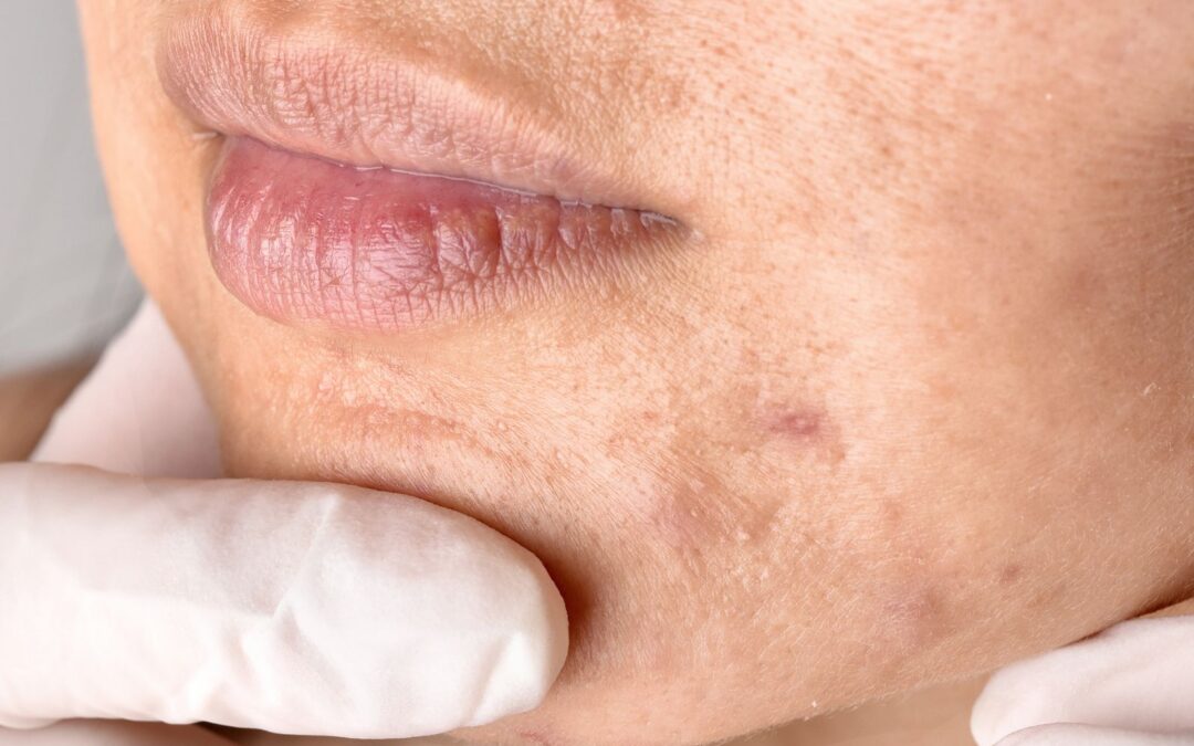 Brown Spots After Summer? Causes & Treatment Options